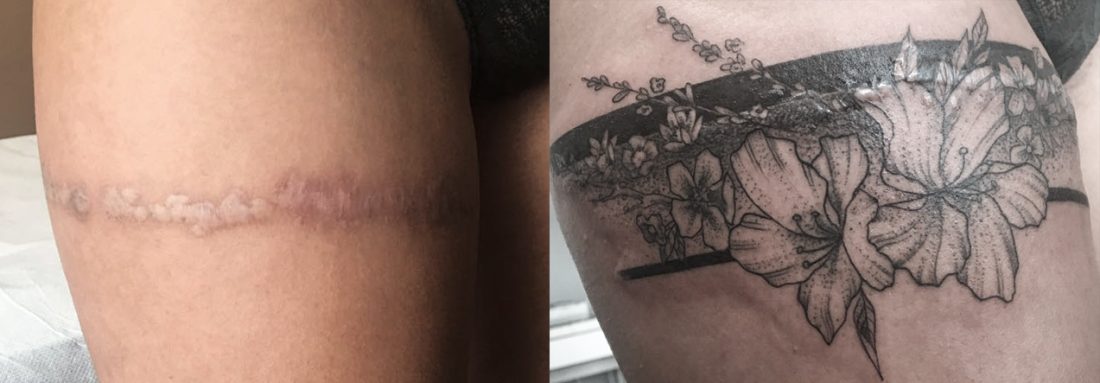 TATTOO ÜBER NARBEN Lines & Dots